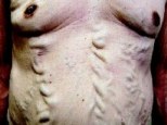 The man who has 'varicose veins' protruding from his CHEST